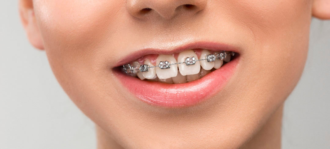 Factors Affecting The Calculation Of Braces Prices